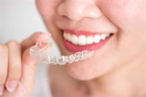 Invisalign Process and Timeline Behind Your Smile - Biid.org