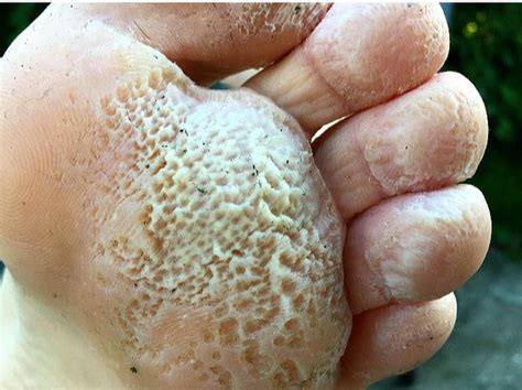 Pitted Keratolysis Hands