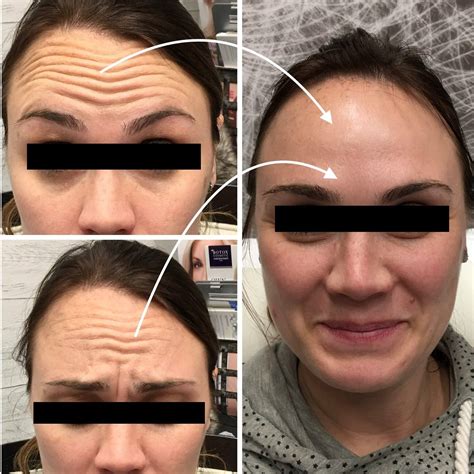 Botox Specialists Rochester, Minnesota - Slow Coast Spa