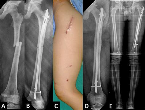 Intramedullary nailing versus submuscular plating in adolescent femoral ...