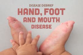 Hand, Foot, and Mouth Disease (HFMD) – National Collaborating Centre ...