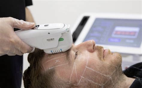Understanding 3D HIFU: A Revolutionary Skincare Treatment - The Harley ...