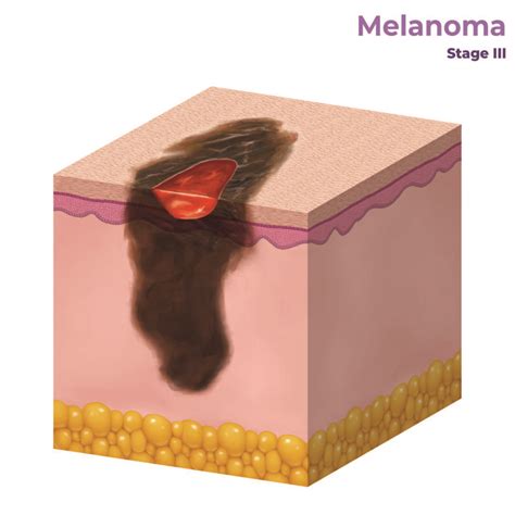 Melanoma Stage 1