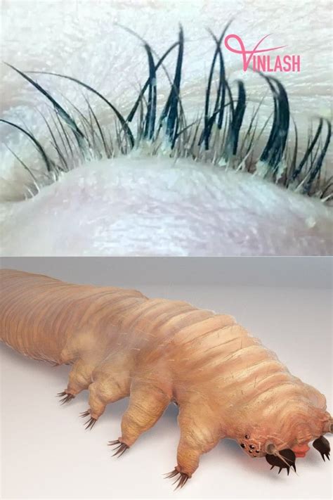 Eyelash Mites Blepharitis NHS
