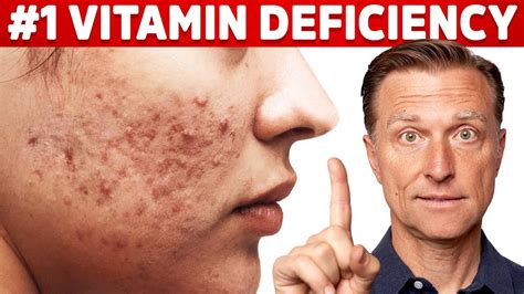 Vitamin D Deficiency Skin Problems