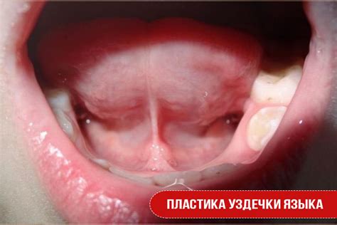 Пластика уздечки языка | Статьи стоматологии в Николаеве