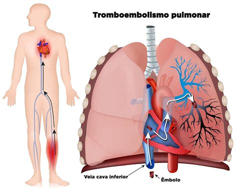O Que Causa Trombose No Pulmão