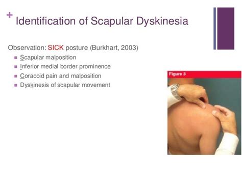 Scapular dyskinesia and its relationship to rotator cuff impingement