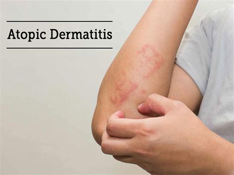 Treatment of Atopic Dermatitis with Natural Herbal Remedies