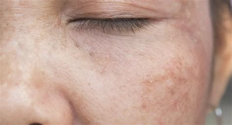 What Is Chloasma (Melasma)? | Healthtian