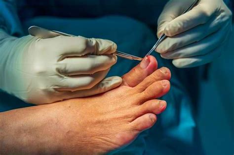 Sekilas tentang Operasi Cabut Kuku dan Perawatannya - Alodokter
