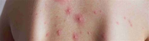Paano makaiwas sa Bulutong o Chickenpox? | Mediko.PH