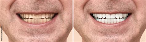 Teeth of a man before and after correction and whitening Stock Photo ...