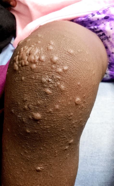gianotti crosti syndrome  benign dermatosis pmc