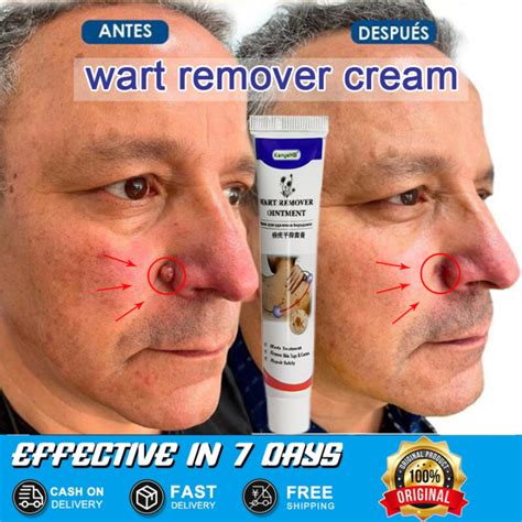 Wart Remover Cream Sumifun Wart Removal Body Warts Treatment Cream Skin Tag Remover Blemish ...