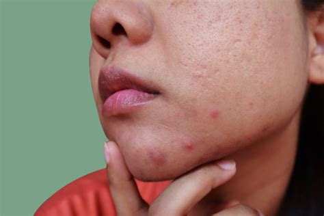 500+ Whitehead Pimple Stock Photos, Pictures & Royalty-Free Images - iStock