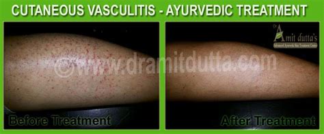 Cutaneous Vasculitis - Ayurvedic Medicine Treatment in India