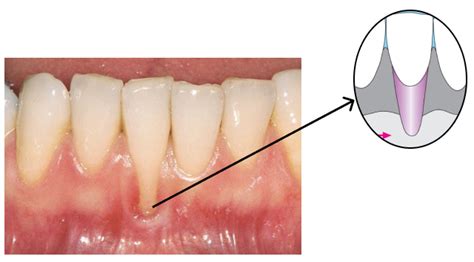 What causes gum recession in one tooth and how to treat it?