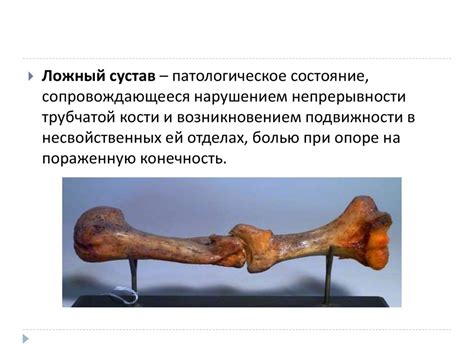 Лечение ложного сустава - презентация онлайн
