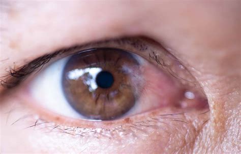 Ocular Surface Disease - Cornea & Cataract Consultants of Arizona