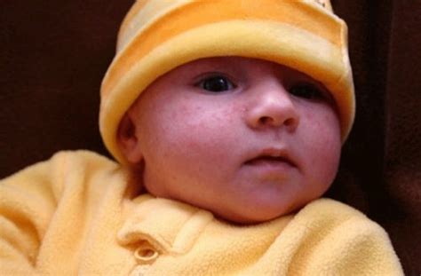 Remédio para curar a brotoeja por excesso de calor em seu bebê