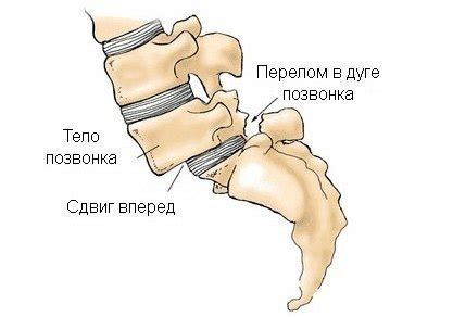 Спондилолистез: степени, причины, симптомы, лечение