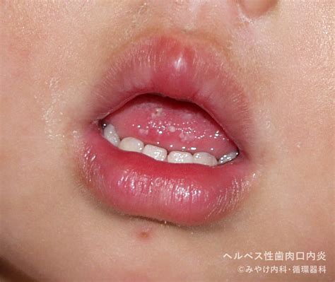 口角炎 ヘルペス | 口角炎とヘルペスの見分け方 – EUOW