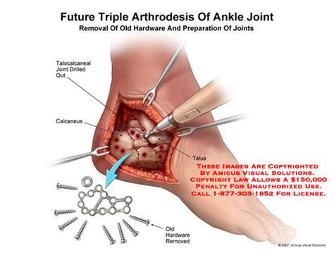 Florida Passport: Ankle Surgery Types