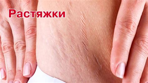 Ферменкол Элактин от растяжек — Эффект лазерного воздействия | Стрии ...