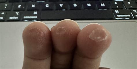 What can you tell based on the calluses. : r/guitarlessons