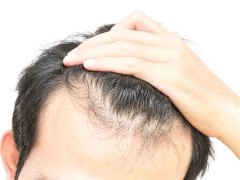 how to grow back lost hair