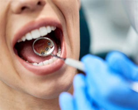 prolia and dental crowns 4