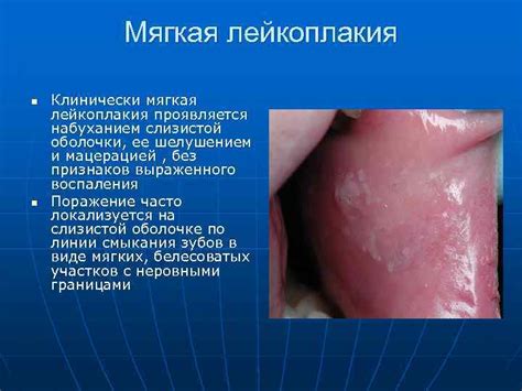 Лейкоплакия Презентация подготовлена к. м. н. Анисимовой И.