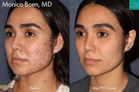 Scar & Acne Scar Treatment | San Diego, CA | CLDerm
