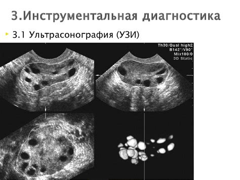 Синдром поликистозных яичников - презентация онлайн