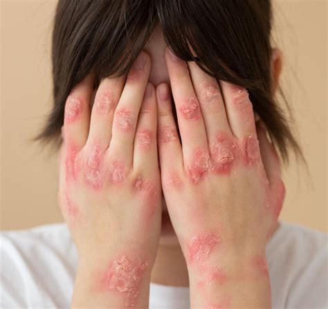 conheca os principais sintomas  lupus associacao medica de londrina