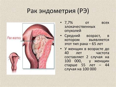 Рак шейки и тела матки - презентация онлайн