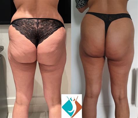Fat Thighs Before And After