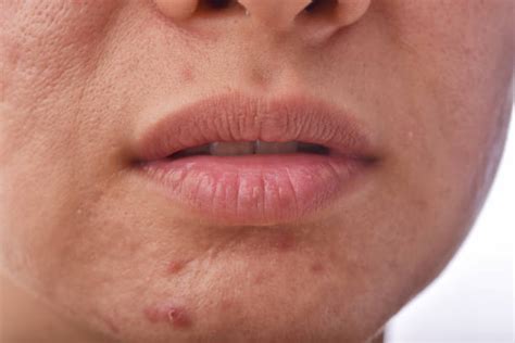 Whitehead Pimple Stock Photos, Pictures & Royalty-Free Images - iStock