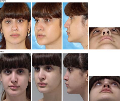 Northern European Nose - Clinical Tree