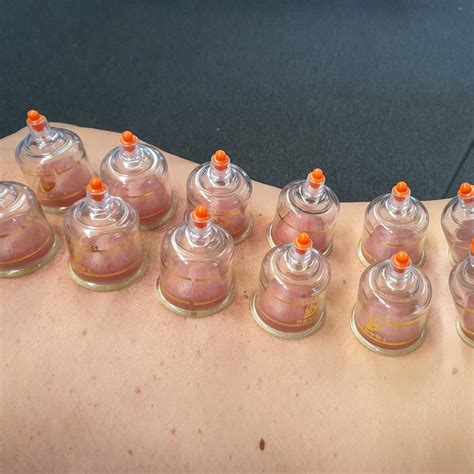 Dry Cupping – CADEYRN Health & Fitness