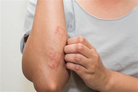 Eczema | Dermatitis | Atopic Dermatitis | MedlinePlus