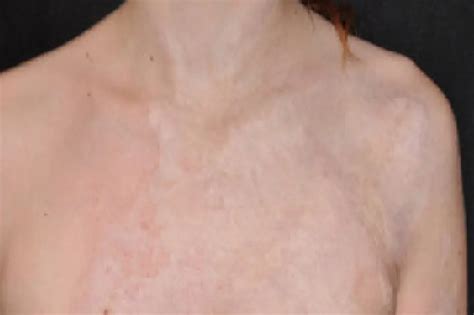 Burn Scars Removal Treatment in Bhubaneswar | Burn Management Doctor