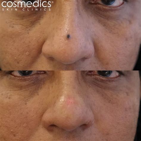 Before & After Photos | London Mole Removal