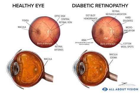 Diabetic Retinopathy