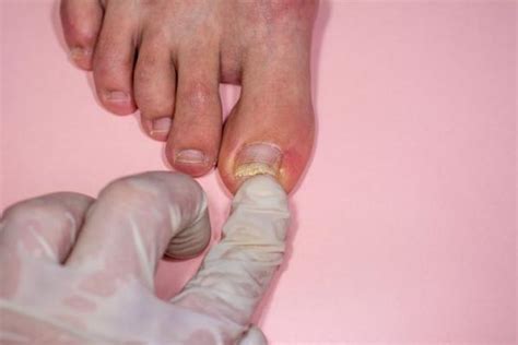 Unhas Que Descolam Da Carne
