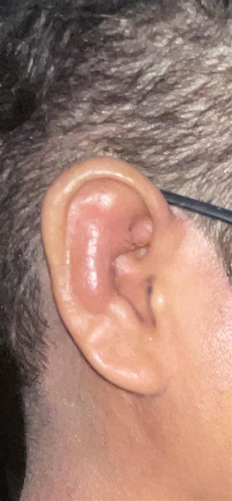 ear  swollen  throbs   apparent trauma  doctors