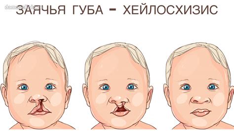 Пластика и реконструкция губ «Заячья губа»