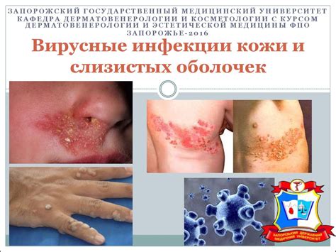 Вирусные инфекции кожи и слизистых оболочек - презентация онлайн