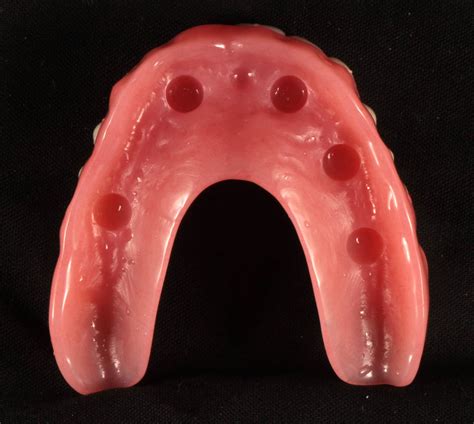 upper   implant overdentures  total implants male